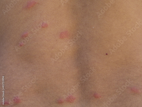 Photo: flea bites flea bites