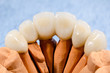 dental crowns, ceramic veneers finished from above