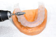 bur with bite splint half finished