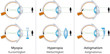 Vision defects (Sehfehler)