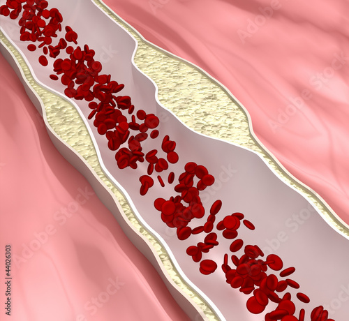 Illustration: Coronary atherosclerosis desease Coronary atherosclerosis desease
