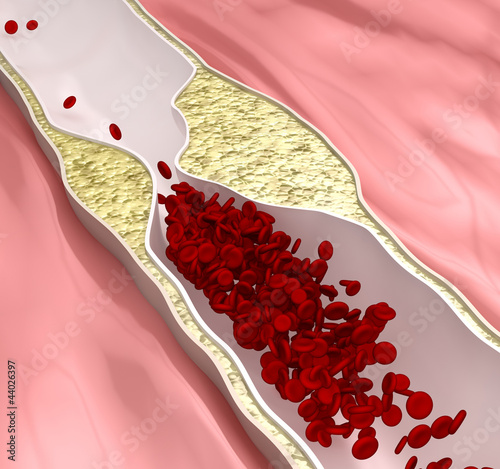 Illustration: Atherosclerosis disease - plague blocking blood flow Atherosclerosis disease - plague blocking blood flow