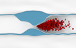 Atherosclerosis disease - plague blocking blood flow