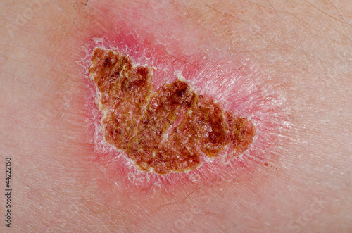 Photo: Burn scar Burn scar