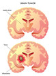 tumore cerebrale