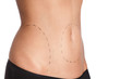 Belly plastic correction, isolated, white background, side view