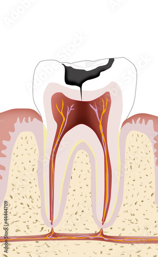 Illustration: Zahn mit Karies, Endodontie 1 Zahn mit Karies, Endodontie 1