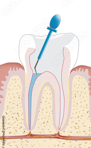 Illustration: Zahnwurzelbehandlung, Endodontie 3 Zahnwurzelbehandlung, Endodontie 3