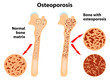 Osteoporosis