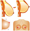 Plastic surgery of breast. Tits correction.