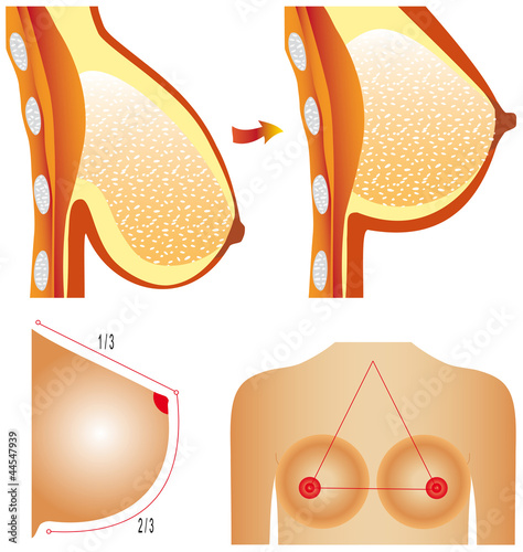 Vector: Plastic surgery of breast. Tits correction. Plastic surgery of breast. Tits correction.