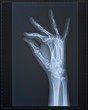 Hand X-ray. Female.