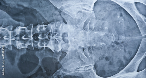 Photo: Lower back X-ray including coxis. Female. Lower back X-ray including coxis. Female.