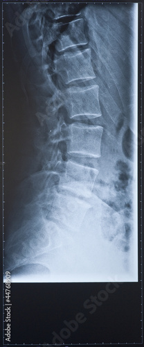 Photo: Back X-ray side view showing the spine. Female. Back X-ray side view showing the spine. Female.