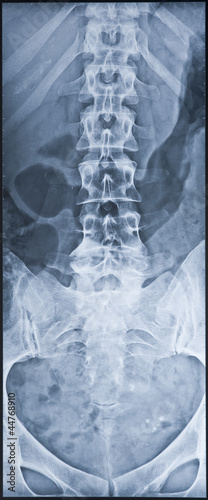 Photo: Back X-ray including coxis and pelvis. Female. Back X-ray including coxis and pelvis. Female.