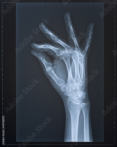 Photo: Hand X-ray. Female. Hand X-ray. Female.