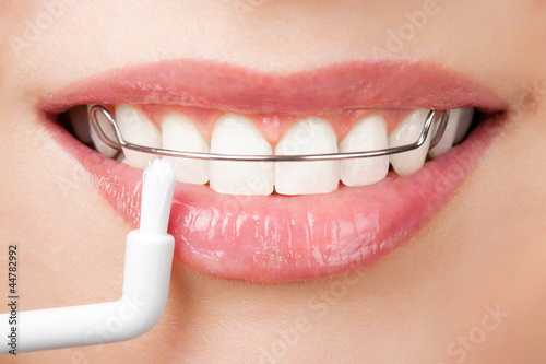 Photo: cleaning teeth with retainer cleaning teeth with retainer