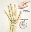Ganglion.Überbein an der Hand
