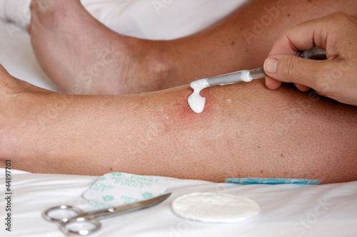 Photo: A sore on a leg A sore on a leg