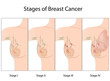 Stages of Breast Cancer, eps10