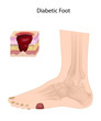 Diabetic Foot , eps10