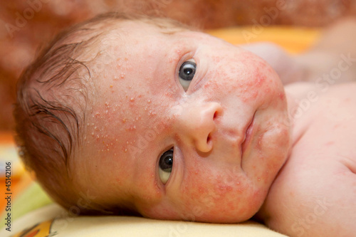 Photo: newborn baby. On face rash, acne neonatorum newborn baby. On face rash, acne neonatorum