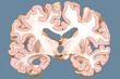 Illustration: alzheimer brain court alzheimer brain court
