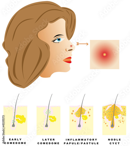 Vector: Acne is divided into four types Acne is divided into four types