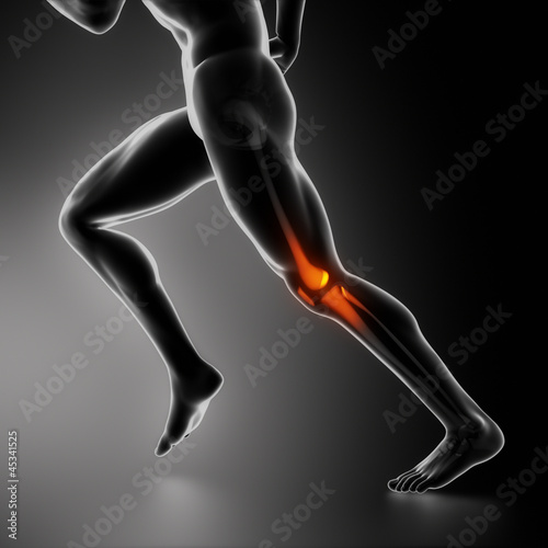 Illustration: Sports knee injury x-ray concept Sports knee injury x-ray concept