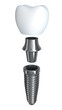 Tooth implant disassembled