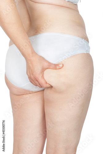 Photo: Women's cellulite Women's cellulite