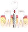 Dental crown procedure