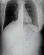 MRI scan of breast cancer