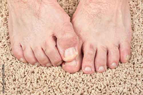 Photo: Itchy feet Itchy feet