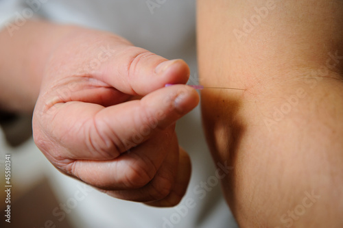 Photo: Acupuncture. Needles being inserted into a patient's skin Acupuncture. Needles being inserted into a patient's skin