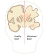 Alzheimer's disease brain, eps8