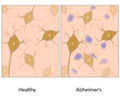 Alzheimer's disease brain tissue with amyloid, eps10