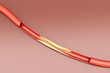 Arteriosklerose