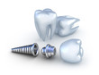 Dental implant and teeth, isolated on white