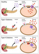 Insulin action and diabetes type 1 and 2, eps8