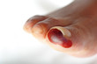 Photo: Dry gangrene Dry gangrene