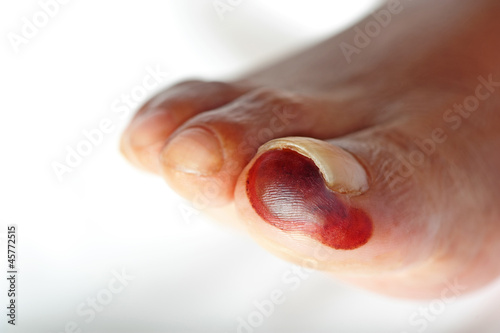 Photo: Dry gangrene Dry gangrene