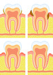 Dental deposit, dental calculus, decay