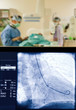 X-ray screen coronarography surgery