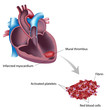 Mural thrombus after heart attack, eps10