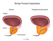 Benign prostatic hyperplasia (BPH), eps10