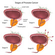 Stages of prostate cancer, eps10