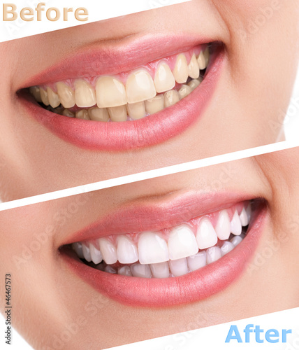 Photo: bleaching teeth treatment bleaching teeth treatment