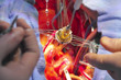artificial heart valve in the implantation process.