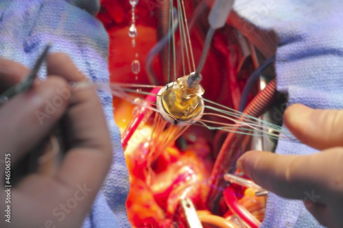 Photo: artificial heart valve in the implantation process. artificial heart valve in the implantation process.